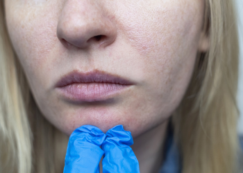 Pigment Reduction & Skin Texture Improvement